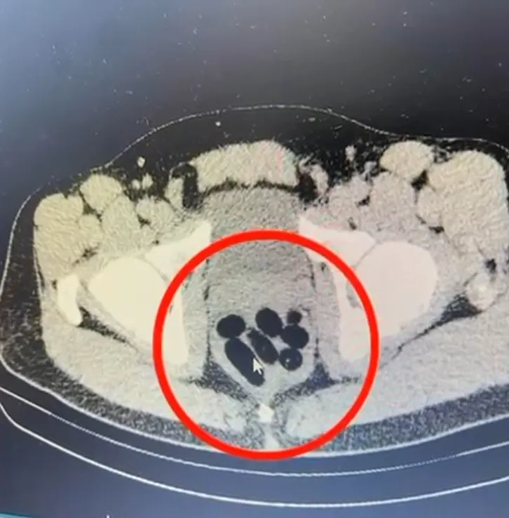 Midesinde 500 gram sentetik uyuşturucu bulundu!